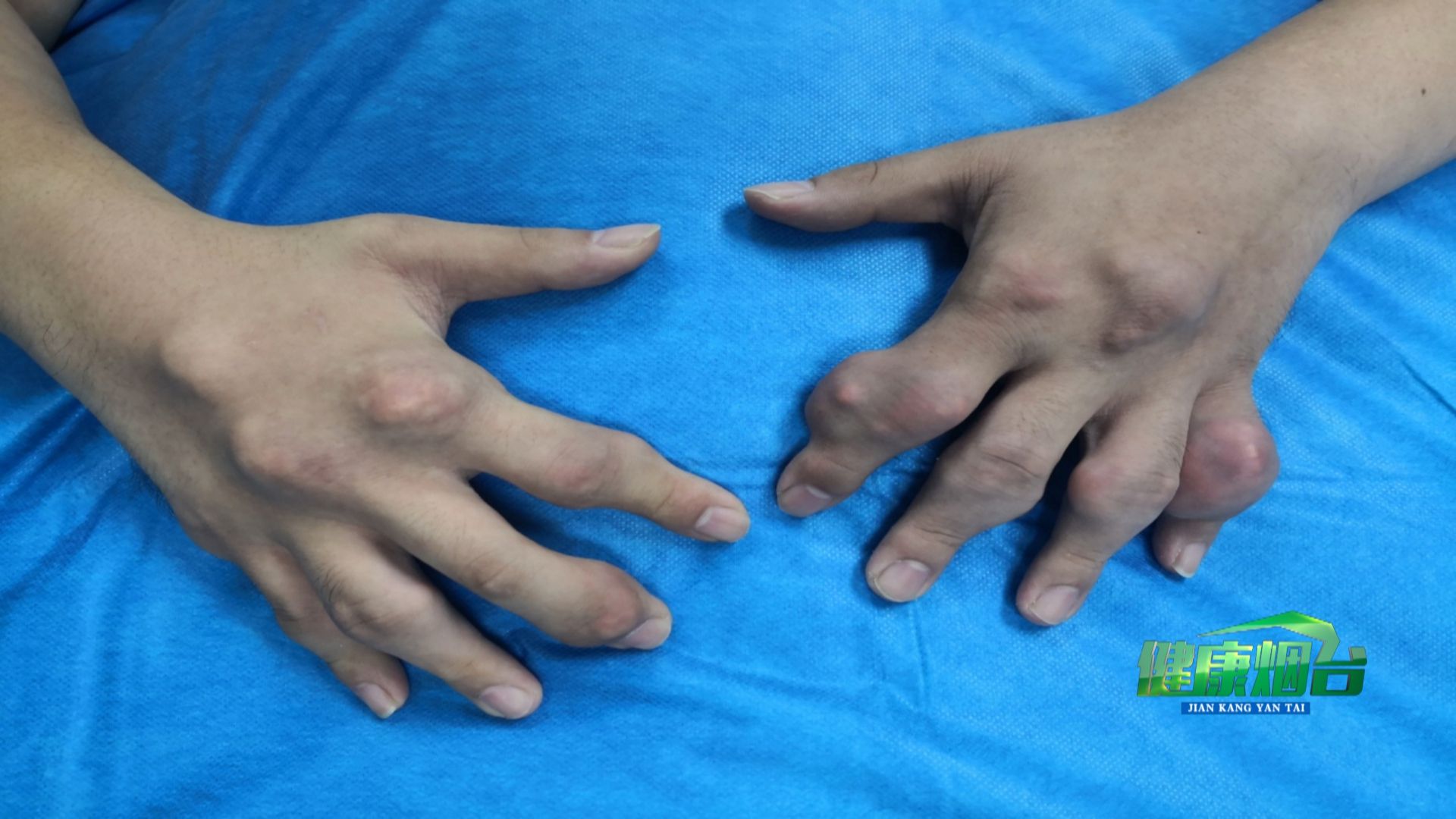 27岁小伙竟有8年痛风病史烟台山医院为其切除30余处痛风石